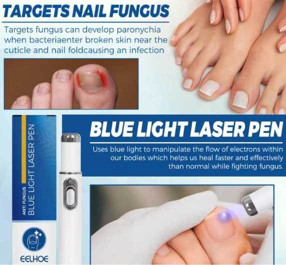 Lapiz Laser Azul Para Hongos En Las Uñas